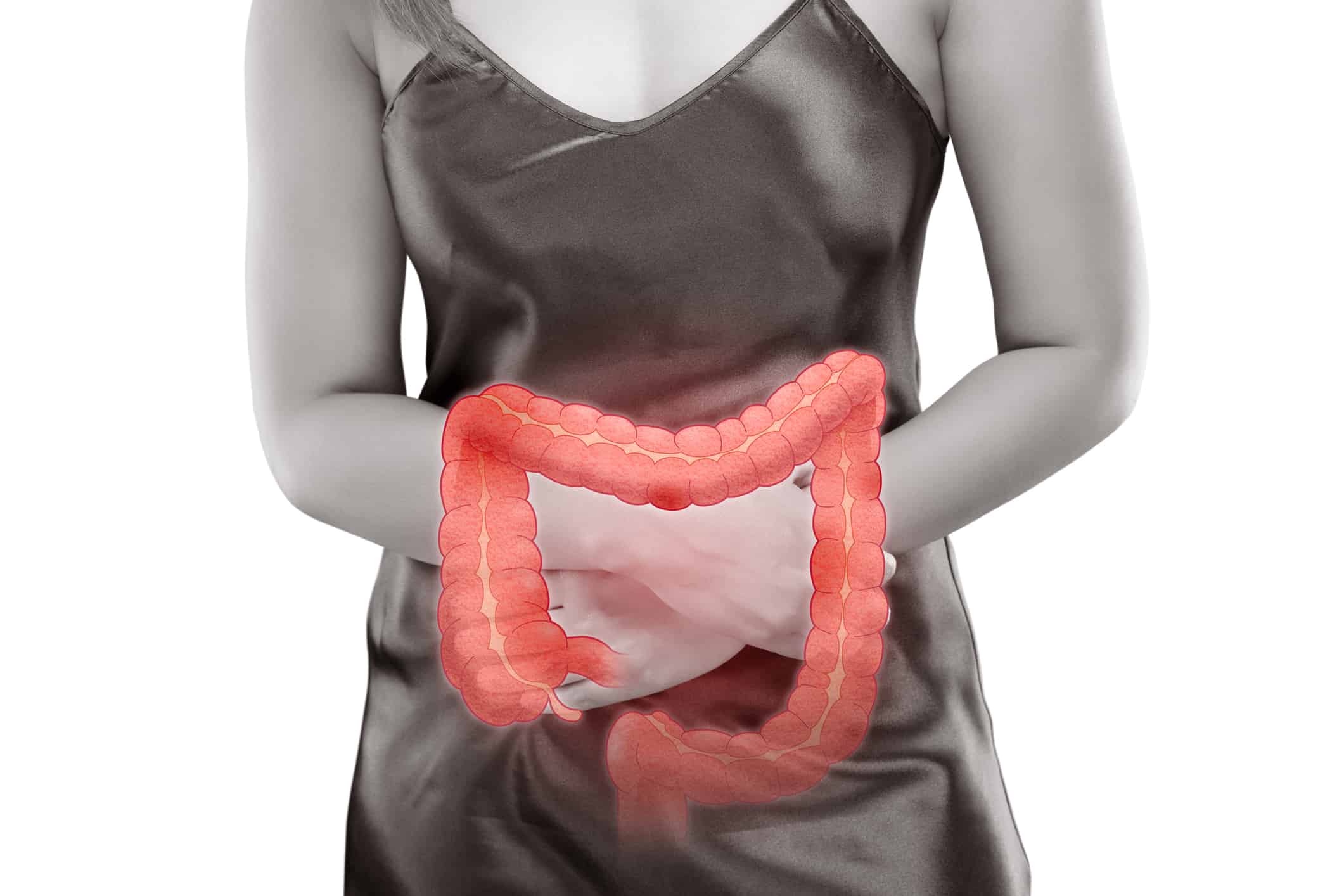 ulcerative colitis