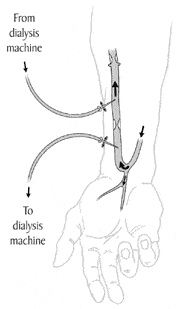 Arm with an arteriovenous fistula.