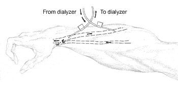 Illustration of an arm with arterial and venous needles.