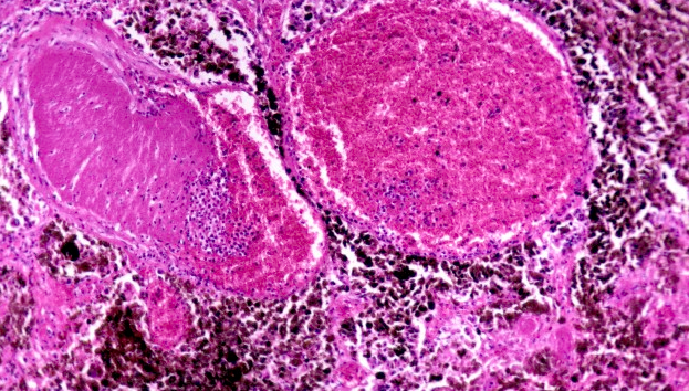 A microscopic image of melanoma