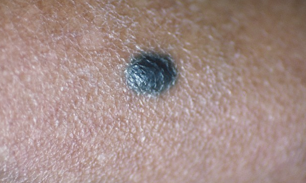 A mole on the skin