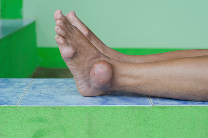 foot of gout patient