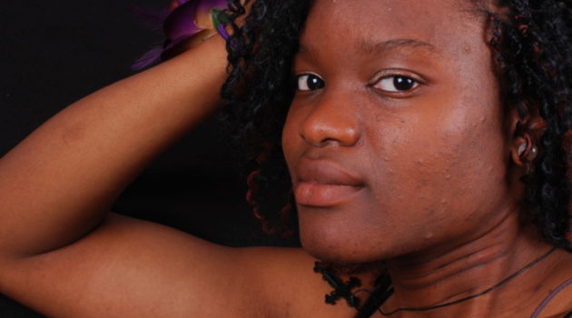 african american woman with acne