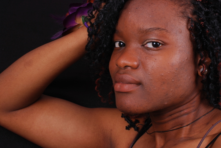 african american woman with acne