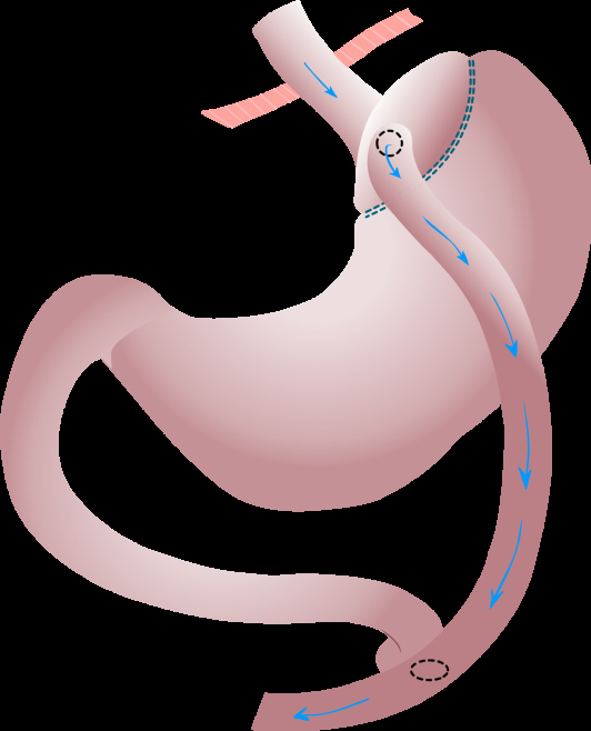 Q&A Is Gastric Bypass Surgery Safe?