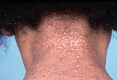 sarcoidosis