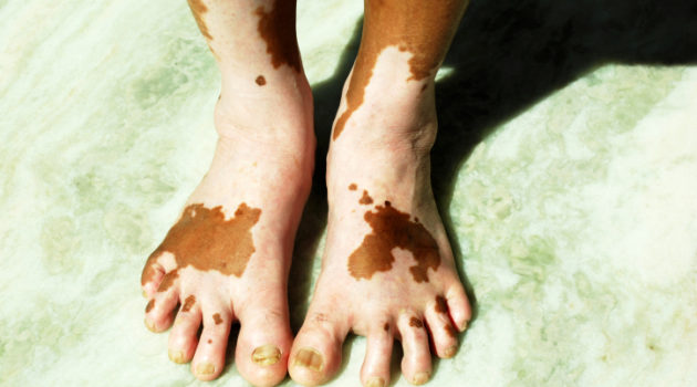 african american vitiligo