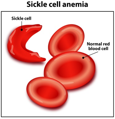 sickle cell graphic