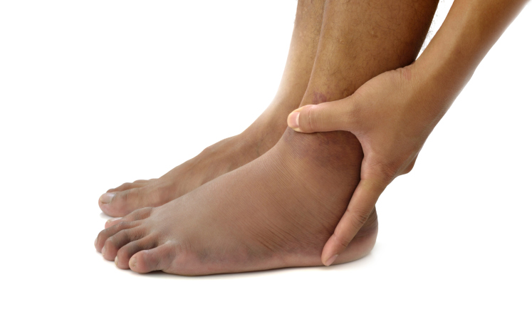 Symptoms of a Leg Blood Clot
