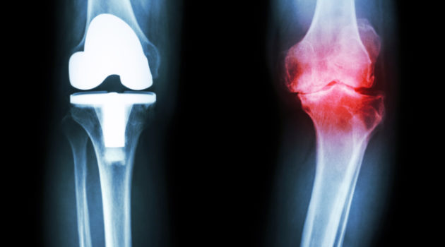 osteoarthritis knee