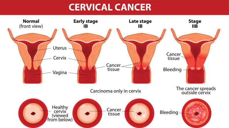 cervical cancer diagram