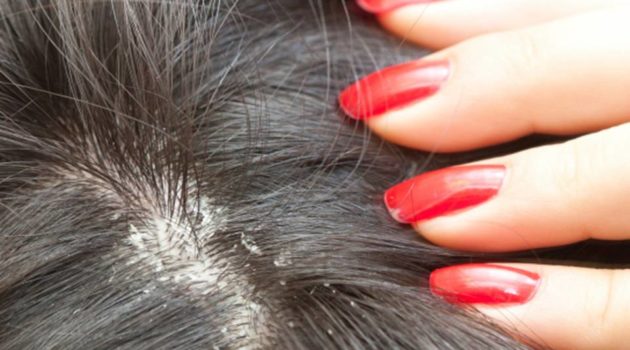 yeast infections on scalp