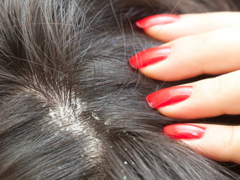 Can You Get Yeast Infections On Scalp 