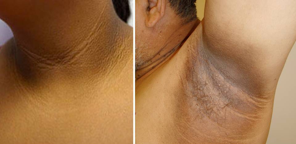 Click here to know about Acanthosis Nigricans and how harmful they are for ...
