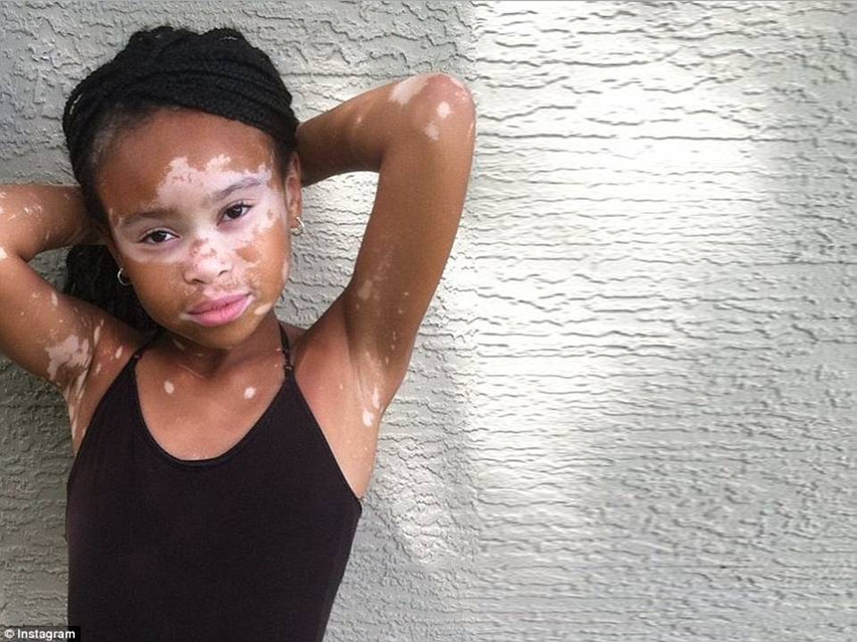 Young Model With Vitiligo Pushes Past Bullies To Redefine Beauty - Page 2 o...