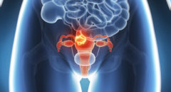 pcos and fibroids