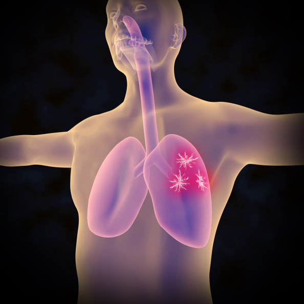 lung cancer human body animation