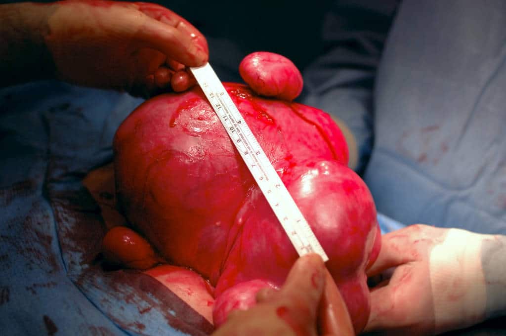This is a massive (2500 grams, 5.5 pounds) diseased human uterus with fibroids. 12MP camera.