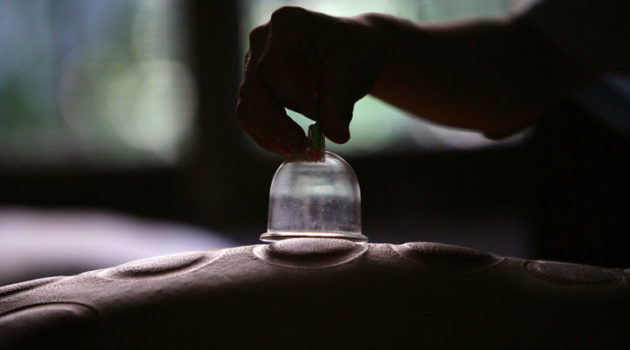chinese cupping treatment