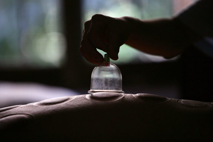 chinese cupping treatment