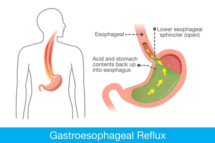 9 Natural Remedies To Get Rid Of Acid Reflux And Heartburn Fast Blackdoctor Org Where Wellness Culture Connect