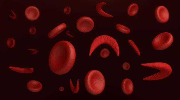 sickle cell red blood cells