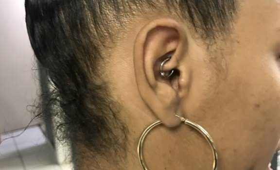 daith piercing for migraines