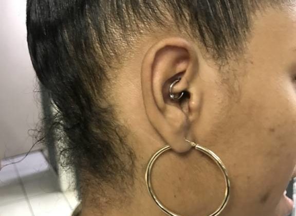 daith piercing for migraines