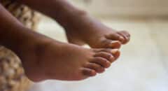 nail fungus