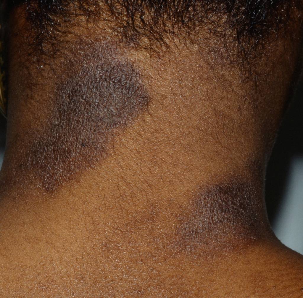 10 Most Common Skin Rashes On Black Skin | Hives On Black Skin