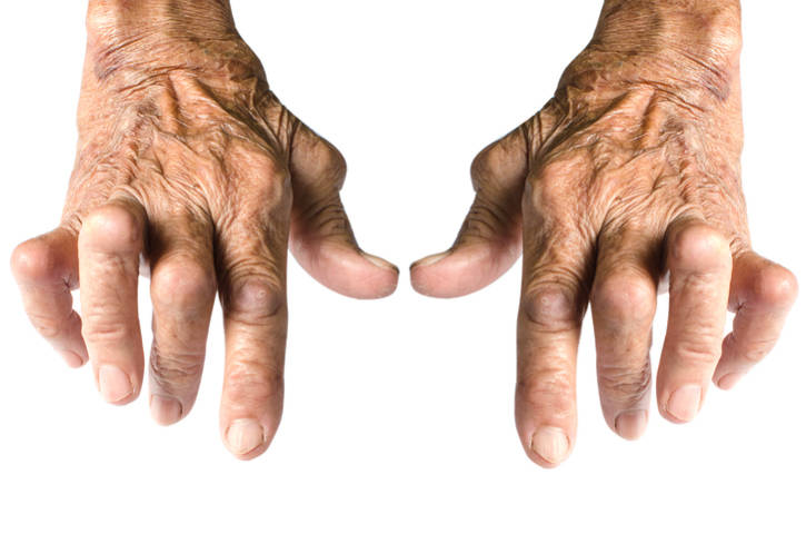 arthritis hands
