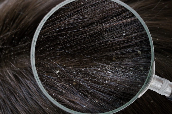 You Think It's Dandruff, But It's Not (And What To Do About It) -   - Where Wellness & Culture Connect