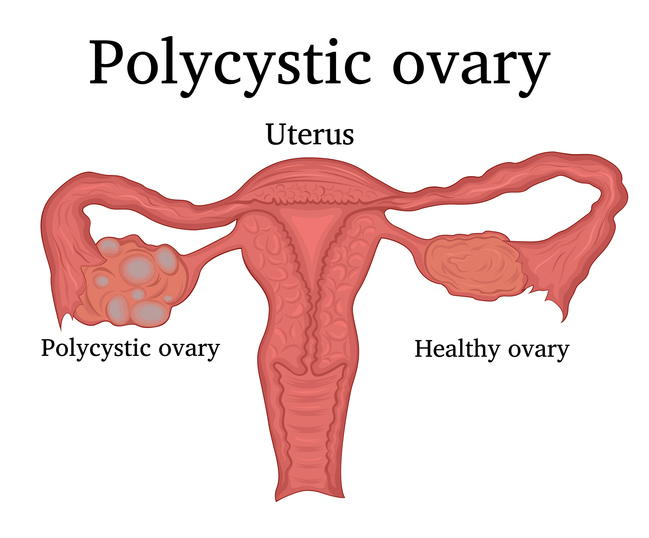polycystic ovary PCOS