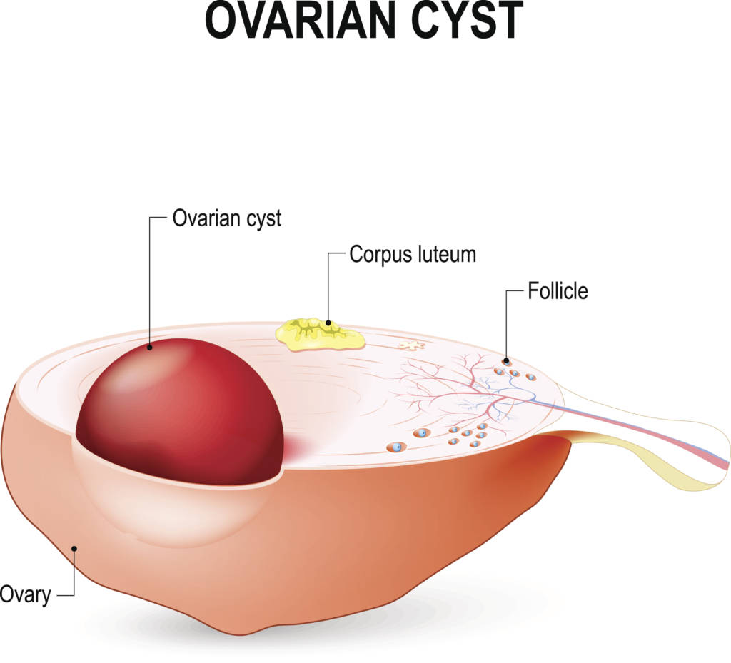 I-fern Products. 001 - What is Ovarian Cyst? An ovarian cyst is a  fluid-filled sac within the ovary. Often they cause no symptoms.  Occasionally they may produce bloating, lower abdominal pain, or