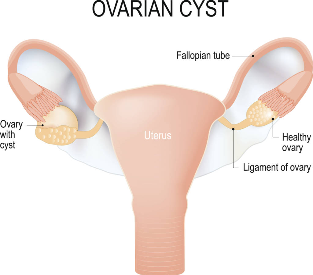Natural Remedies For Ovarian Cysts