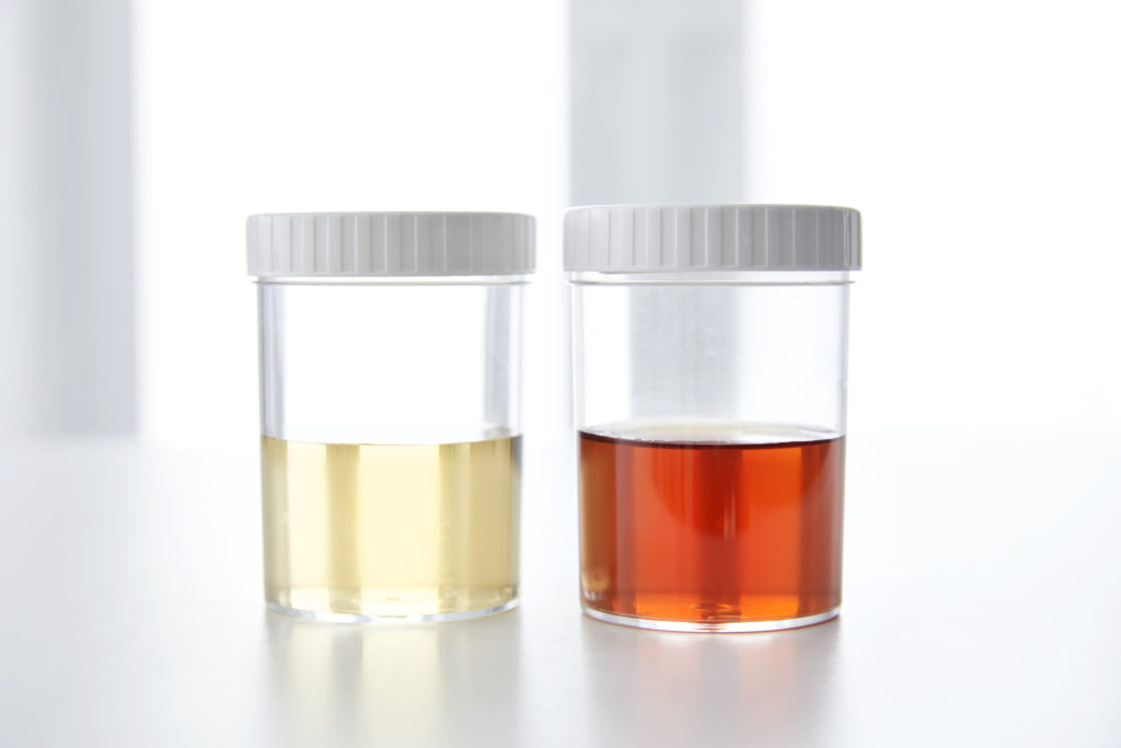 What Causes Bright Blood In Urine