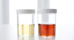 Blood in human urine in sample pot