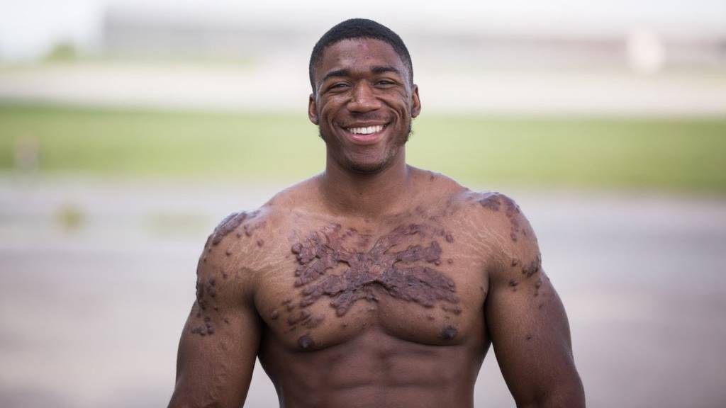 Isaiah Griffin: Scarred But Never Scared - BlackDoctor.org - Where Wellness  & Culture Connect