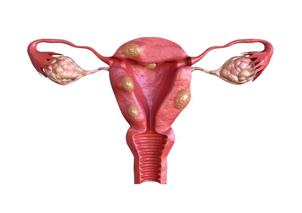 Shrink Uterine Fibroids