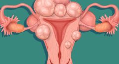 how to shrink fibroids naturally
