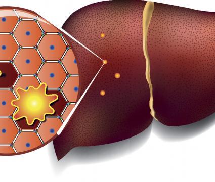 Liver Cells Attacked by Toxins