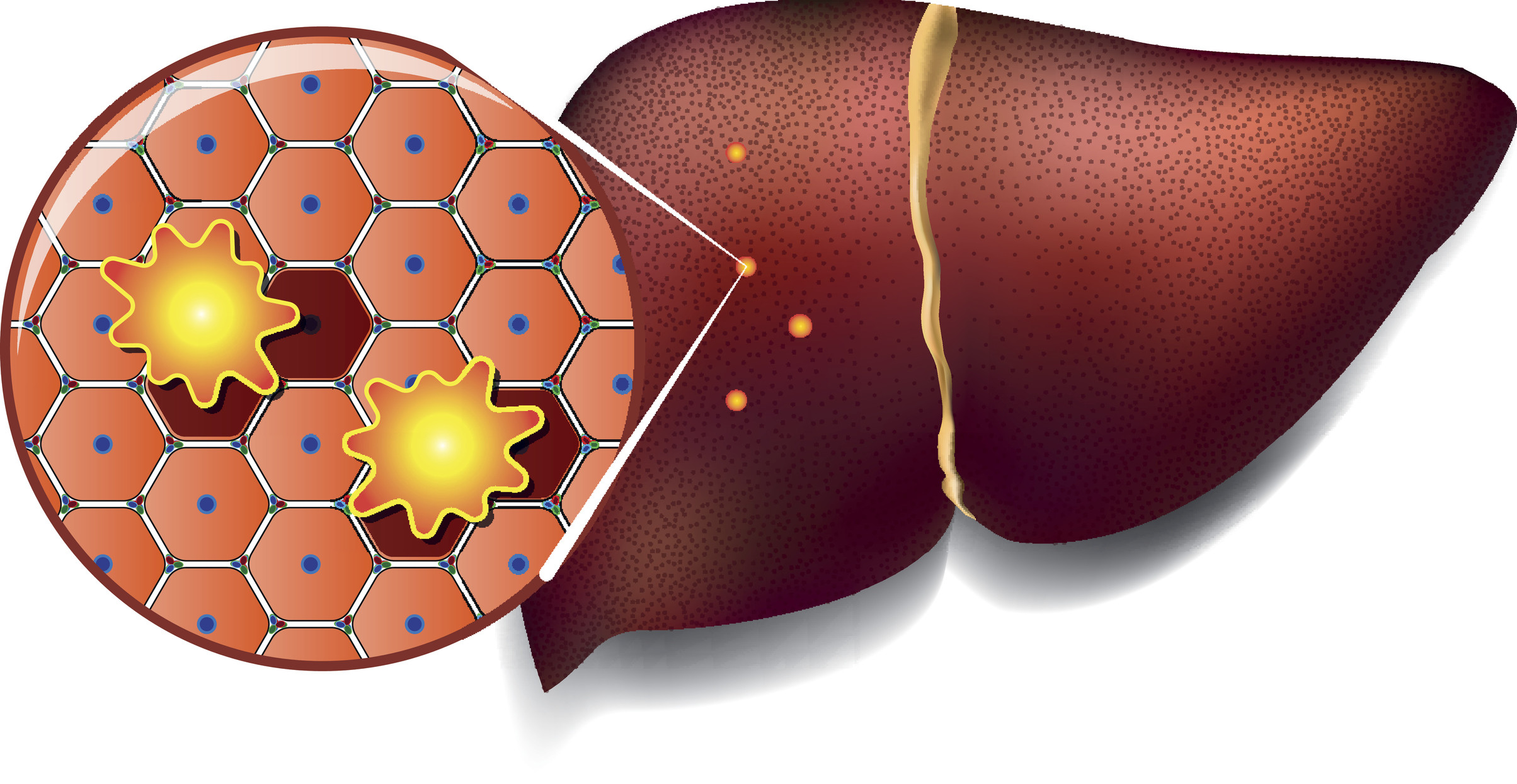 Liver Cells Attacked by Toxins
