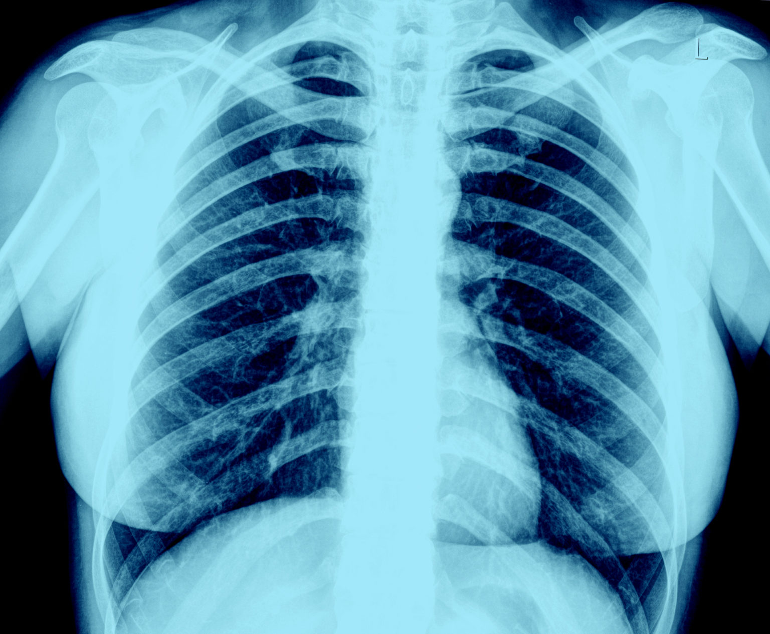 СТО рентгенограмм грудной клетки