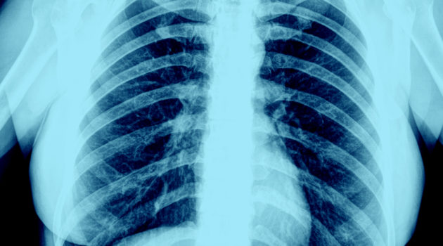 Late-Stage Lung Cancer