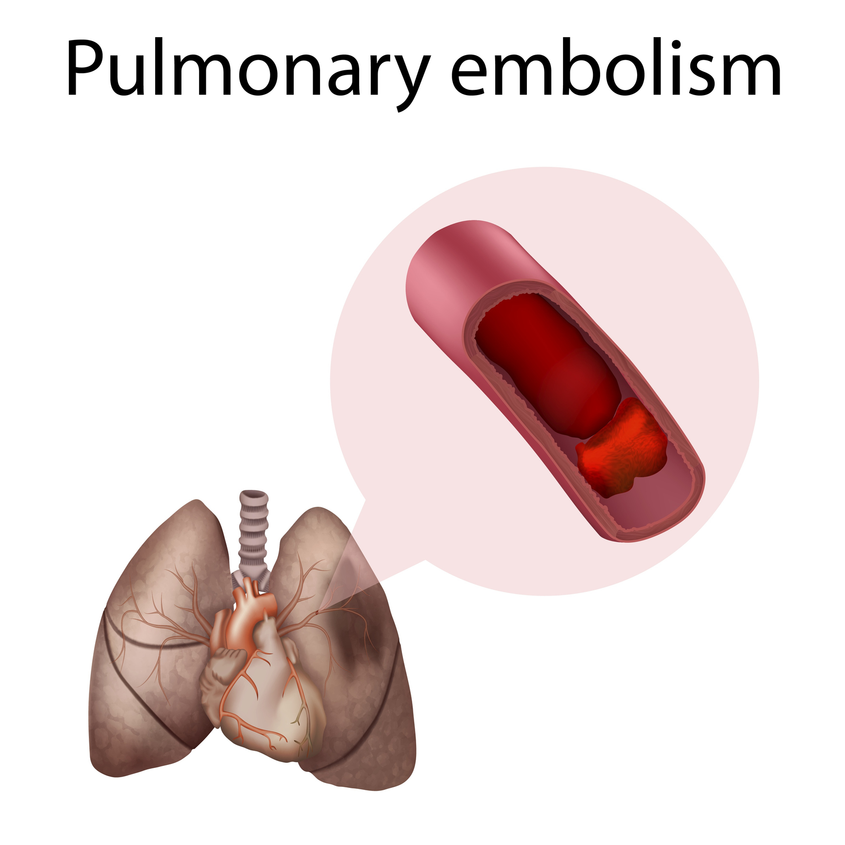 alert-study-shows-blood-clots-fill-lungs-of-black-covid-19-victims