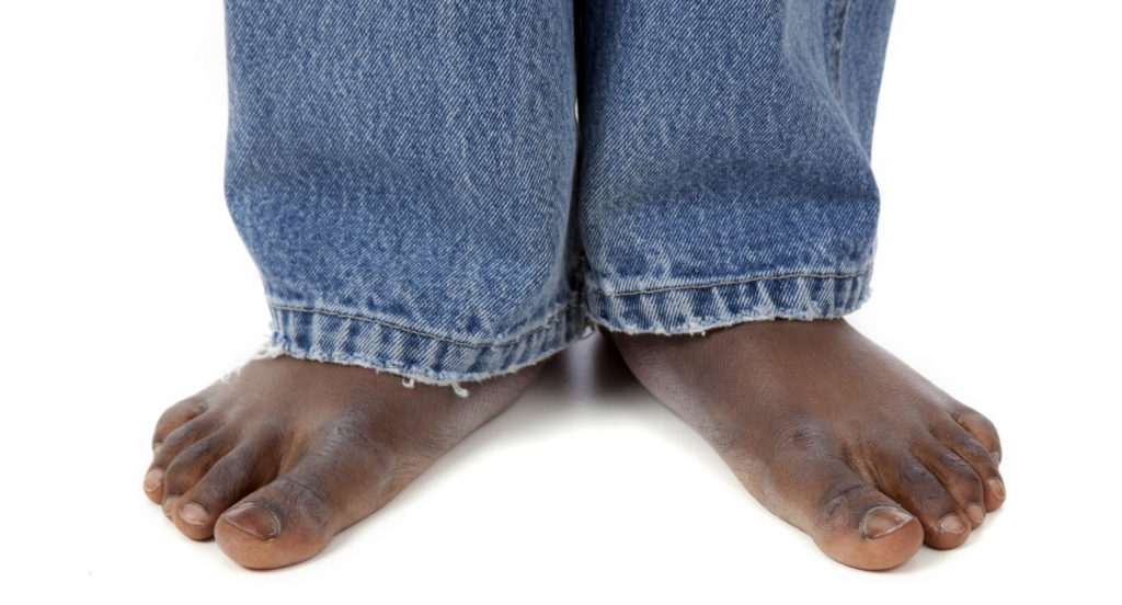 COVID Toes Might Be A Sign You Had The Disease BlackDoctor Org   GettyImages 182362015 E1589319511356 1024x552 