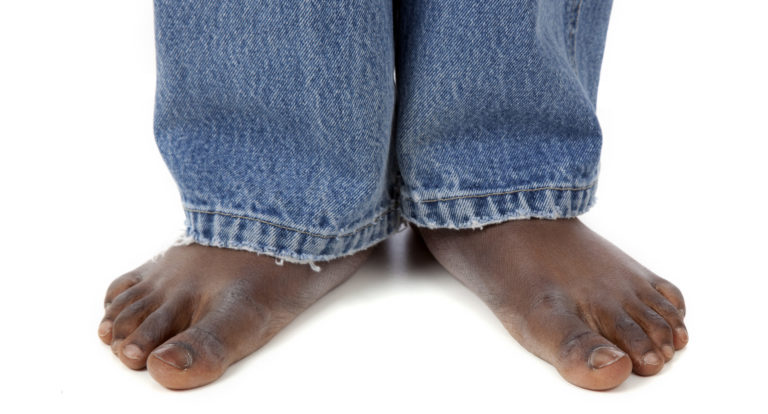 'COVID Toes' Might Be a Sign You Had the Disease - BlackDoctor.org