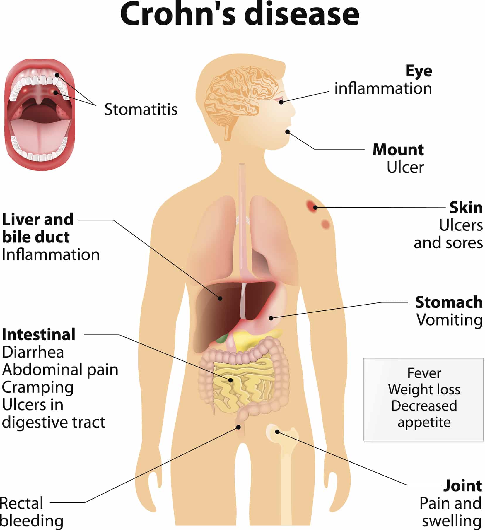 Crohn's Disease: Could You Have It and Not Know? - BlackDoctor.org