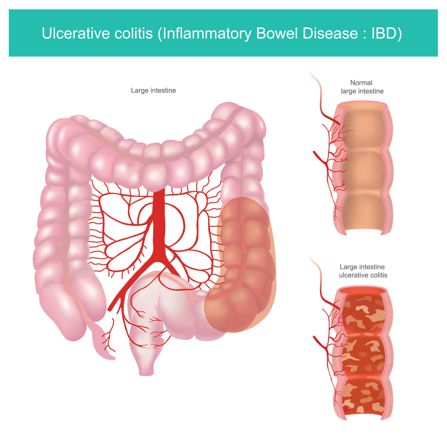 Ulcerative Colitis What It Is What It Isn T And Why You Should Care