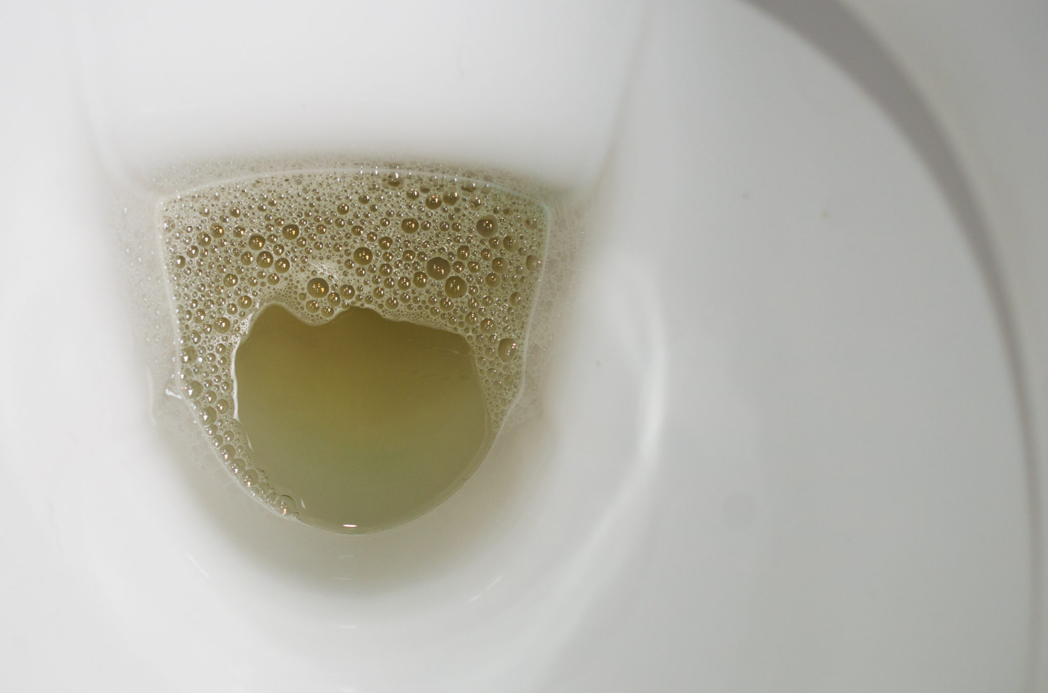 tiny bubbles in urine